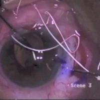 Transfixion of Foldable Intraocular Lens with Polytetrafluoroethylene Suture for Scleral Fixation