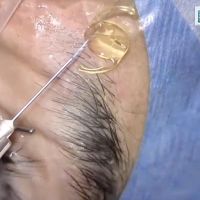 Fijacion escleral de LIO con sutura permanente al mismo