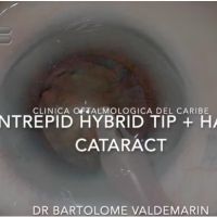 Intrepid Hybrid tip + Hard Cataract