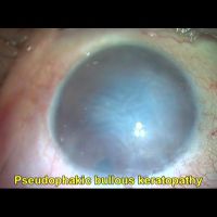 Pseudophakic bullous keratopathy managed with triple procedure of -PDEK with glued IOL and Single pass 4 throw pupilloplasty